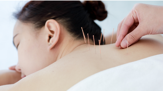 Acupuncture and Its Benefits During Menopause